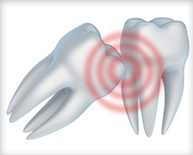 Impacted Teeth Need Immediate Wisdom Tooth Removal Treatment At Our Boise Office.