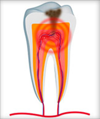 Root Canals Help With Infection - Endodontics For Meridian ID Patients