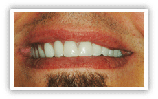 After photo of a smile improved with porcelain veneers.