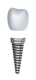 teeth implants from Blaisdell Family Dentistry serving Boise and Meridian ID