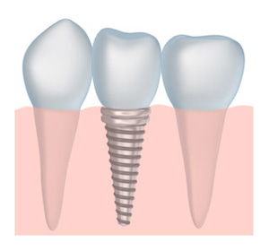 Illustration explaining how dental implants work