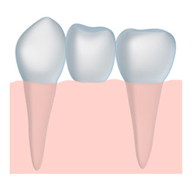 Treat missing teeth with dentures near Eagle ID