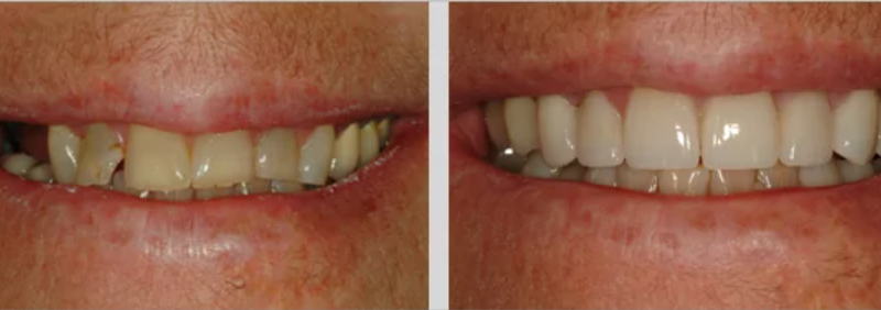 A before and after photo of a Blaisdell Family Dentistry restorative treatment patient.