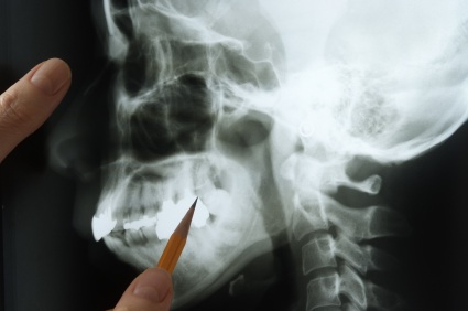 An X-ray of a jawbone being examined by a dentist in Boise.